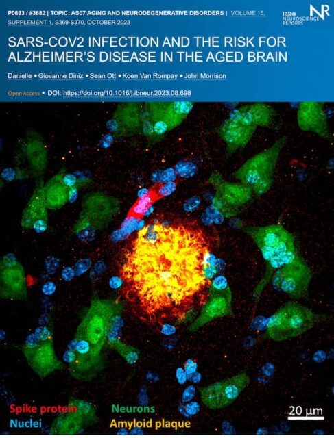 Link Between COVID-19 and Alzheimer's Risk Unveiled in Monkey Brain Study