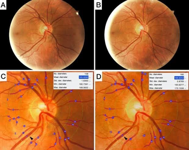 COVID-19's Impact on Vision: Insights into Retinal Disorders and Vision Damage