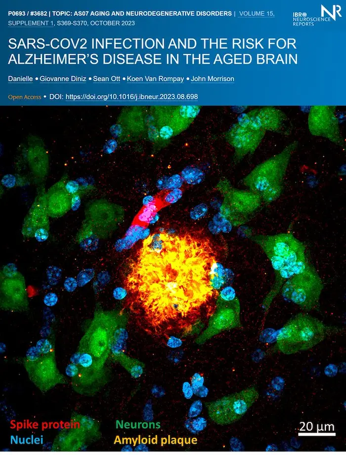 Ist #COVID19 ein Risikofaktor für Alzheimer? Die meisten Primaten entwickeln natürlich senile Plaques (Ablagerungen des Beta-Amyloid-Proteins), eines der fehlgefalteten Proteine, die beim normalen Altern und bei der Alzheimer-Krankheit im Gehirn ansammeln. Da auch Affen #SARSCoV2 bekommen können und ähnliche Symptome wie Menschen entwickeln, haben wir begonnen zu untersuchen, was in den Gehirnen alternder Affen passiert, sobald sie infiziert sind.